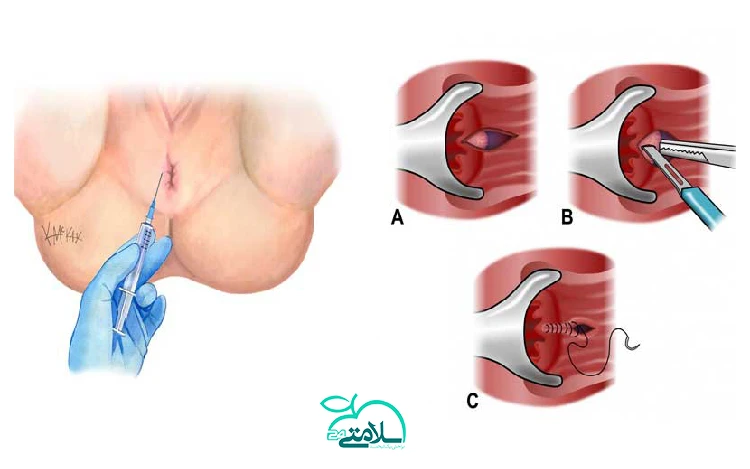 تمام آنچه که باید درباره بوتاکس مقعد بدانید